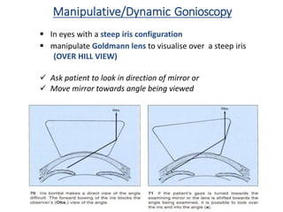 Manipulative/Dynamic Gonioscopy
 In eyes with a steep iris configuration
 manipulate Goldmann lens to visualise over a steep iris
(OVER HILL VIEW)
 Ask patient to look in direction of mirror or
 Move mirror towards angle being viewed
 
