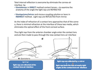 Li < Lr
lightraysarerefractedatthe
contact lens-air interface
lightraysarereflectedbya mirror
lightraysleavethelensatnearlyright
anglesatthecontactlens-air interface
Total internal reflection is overcome by eliminate the cornea-air
interface by
Goniolenses in DIRECT method contact lenses –-to examine the
anatomy of the angle the light rays are REFRACTED
Gonioprisms/mirror and viscous coupling solution or tears in
INDIRECT method . Light rays are REFLECTED from mirror.
As the index of refraction of a contact lens approaches that of the corne
a, there is minimal refraction at the interface of these two media, which
eliminates the optical effect of the front corneal surface.
Thus light rays from the anterior chamber angle enter the contact lens
and are then made to pass through the new contact lens-air interface
 
