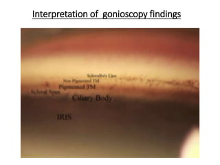 Interpretation of gonioscopy findings
 