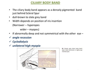 CILIARY BODY BAND
• The ciliary body band appears as a densely pigmented band
just behind Scleral Spur
• dull-brown to slate grey band
• Width depends on position of iris insertion
(Narrower -- hyperopes
wider – myopes)
• If abnormally deep and not symmetrical with the other eye –
 angle recession
 Cyclodialysis
 unilateral high myopia
 