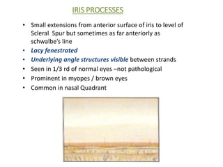 IRIS PROCESSES
• Small extensions from anterior surface of iris to level of
Scleral Spur but sometimes as far anteriorly as
schwalbe’s line
• Lacy fenestrated
• Underlying angle structures visible between strands
• Seen in 1/3 rd of normal eyes –not pathological
• Prominent in myopes / brown eyes
• Common in nasal Quadrant
 