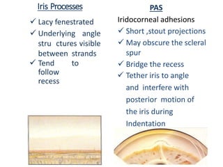Iris Processes
 Lacy fenestrated
 Underlying angle
stru ctures visible
between strands
 Tend to
follow
recess
PAS
Iridocorneal adhesions
 Short ,stout projections
 May obscure the scleral
spur
 Bridge the recess
 Tether iris to angle
and interfere with
posterior motion of
the iris during
Indentation
 