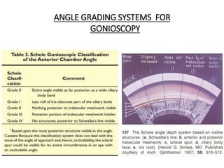 ANGLE GRADING SYSTEMS FOR
GONIOSCOPY
 
