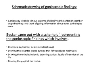 Schematic drawing of gonioscopic findings:
• Gonioscopy involves various systems of classifying the anterior chamber
angle but they stop short of giving information about other pathologies
seen.
Becker came out with a scheme of representing
the gonioscopic findings which involves:-
• Drawing a dark circle( depicting scleral spur)
• Drawing three lighter circles outside that for trabecular meshwork.
• Drawing three circles inside it, depicting various levels of insertion of the
iris.
• Drawing the pupil at the centre.
 
