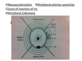A)Neovascularisation B)Peripheral anterior synechiae
C)Level of insertion of iris
D)Peripheral iridectomy
 