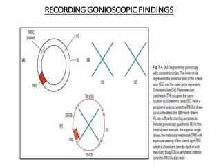 RECORDINGGONIOSCOPICFINDINGS
 