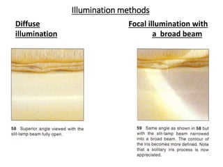 Illumination methods
Diffuse
illumination
Focal illumination with
a broad beam
 