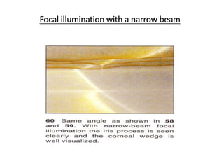 Focal illumination with a narrow beam
 