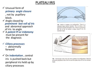 PLATEAU IRIS
 Unusual form of
primary angle closure
, not by pupillary
block.
 Angle closed by
prominent last roll of iris
and abnormal approach
of iris to angle
 A patent PI or iridotomy
must be present for
the diagnosis
 Ciliary processes
– abnormally
forward
 On indentation , central
iris is pushed back but
peripheral iris held up by
ciliary processes
 