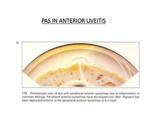 PAS IN ANTERIOR UVEITIS
 