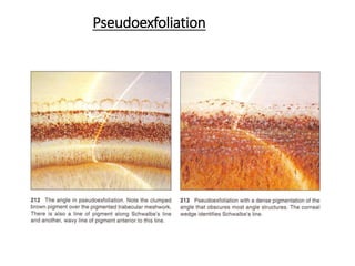 Pseudoexfoliation
 