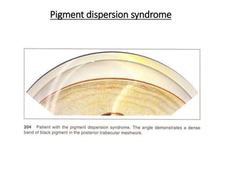 Pigment dispersion syndrome
 