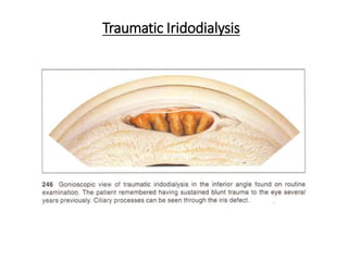 Traumatic Iridodialysis
 