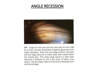 ANGLE RECESSION
 