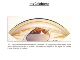 Iris Coloboma
 