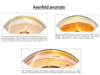 Axenfeld anomaly
 