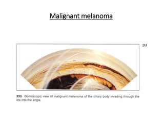 Malignant melanoma
 
