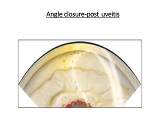 Angle closure-post uveitis
 