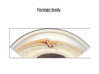Foreign body
 