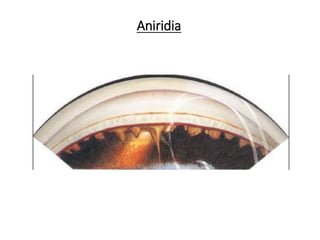 Aniridia
 