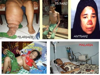 TB PARU

FILARIASIS

DEMAM
BERDARAH

ANTRAKS
MALARIA

 