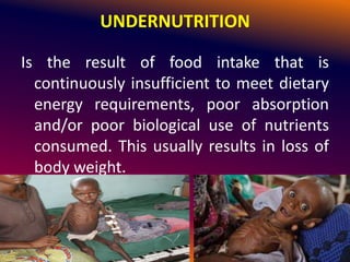 UNDERNUTRITION
Is the result of food intake that is
continuously insufficient to meet dietary
energy requirements, poor absorption
and/or poor biological use of nutrients
consumed. This usually results in loss of
body weight.
 