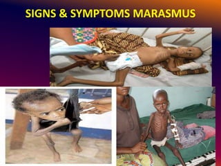 SIGNS & SYMPTOMS MARASMUS
 