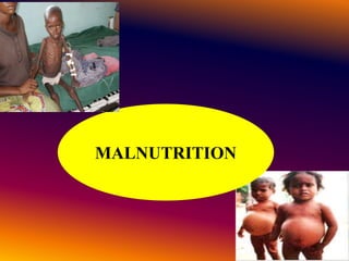 MALNUTRITION
 