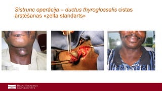 27
Sistrunc operācija – ductus thyroglossalis cistas
ārstēšanas «zelta standarts»
 