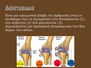 Διάστρεμμα
Είναι μια τραυματική βλάβη της άρθρωσης όπου οι
σύνδεσμοι που τη συγκρατούν είτε διατάσσονται (1),
είτε σχίζονται (2) είτε ρηγνύονται (3).
Δημιουργείται μια προσωρινή απομάκρυνση των δύο
άκρων των οστών.
1
Διάταση
2
Σχίσιμο
3
Ρήξη
Ρήξη
χιαστού
 