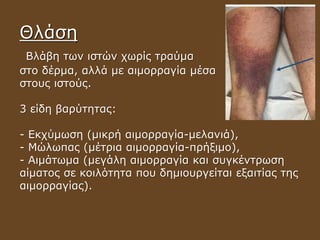 Θλάση
Βλάβη των ιστών χωρίς τραύμα
στο δέρμα, αλλά με αιμορραγία μέσα
στους ιστούς.
3 είδη βαρύτητας:
- Εκχύμωση (μικρή αιμορραγία-μελανιά),
- Μώλωπας (μέτρια αιμορραγία-πρήξιμο),
- Αιμάτωμα (μεγάλη αιμορραγία και συγκέντρωση
αίματος σε κοιλότητα που δημιουργείται εξαιτίας της
αιμορραγίας).
 