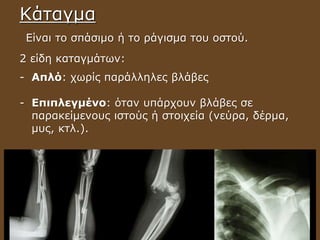 Κάταγμα
Είναι το σπάσιμο ή το ράγισμα του οστού.
2 είδη καταγμάτων:
- Απλό: χωρίς παράλληλες βλάβες
- Επιπλεγμένο: όταν υπάρχουν βλάβες σε
παρακείμενους ιστούς ή στοιχεία (νεύρα, δέρμα,
μυς, κτλ.).
 