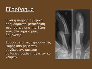 Εξάρθρημα
Είναι η πλήρης ή μερική
απομάκρυνση-μετατόπιση
των οστών από την θέση
τους στο σημείο μιας
άρθρωσης.
Συνοδεύεται τις περισσότερες
φορές από ρήξη των
συνδέσμων, κάκωση
μαλακών μορίων, αγγείων και
νεύρων.
 