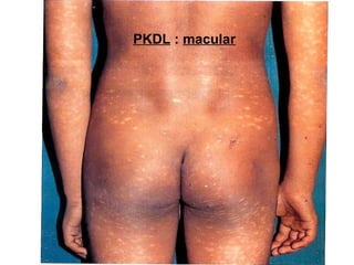 PKDL : macular

 