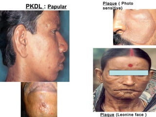 PKDL : Papular

Plaque ( Photo
sensitive)

Plaque (Leonine face )

 