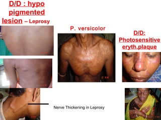 D/D : hypo
pigmented
lesion – Leprosy

P. versicolor

Nerve Thickening in Leprosy

D/D:
Photosensitive
eryth.plaque

 