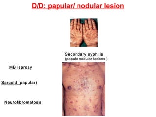 D/D: papular/ nodular lesion

Secondary syphilis
(papulo nodular lesions )
MB leprosy

Sarcoid (papular)

Neurofibromatosis

 