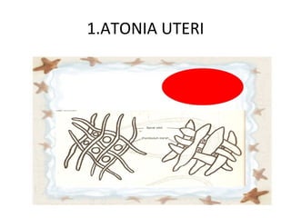 1.ATONIA UTERI
 