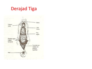 Derajad Tiga
 