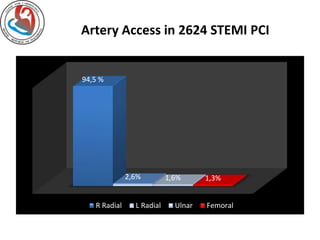 Artery Access in 2624 STEMI PCI 
94,5 % 
2,6% 1,6% 1,3% 
R Radial L Radial Ulnar Femoral 
 