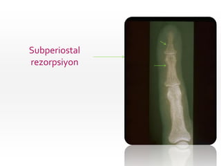 Subperiostal
rezorpsiyon
 