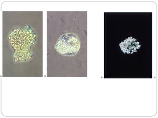 (a) A large aggregate of lipid droplets.
(b) A macrophage partly gorged with lipid droplets (a so-called 'oval fat body').
(c) Maltese crosses
 