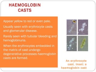 HAEMOGLOBIN
CASTS
An erythrocyte
cast. Inset: a
haemoglobin cast
Appear yellow to red or even pale.
Usually seen with erythrocyte casts
and glomerular disease.
Rarely seen with tubular bleeding and
hemoglobinuria.
When the erythrocytes embedded in
the matrix of cast undergo
degenerative processes haemoglobin
casts are formed.
 