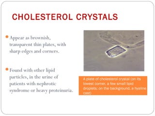 CHOLESTEROL CRYSTALS
Appear as brownish,
transparent thin plates, with
sharp edges and corners.
Found with other lipid
particles, in the urine of
patients with nephrotic
syndrome or heavy proteinuria.
A plate of cholesterol crystal (on its
lowest corner, a few small lipid
droplets; on the background, a hyaline
cast)
 