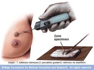 biopsi : 1. sakteson dianozen.2. percakton graden3. ndihmon ne stadifikim
 