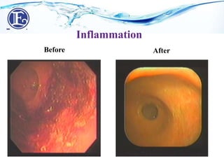 Before After
Inflammation
 