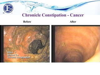 Before After
Chronicle Constipation - Cancer
 