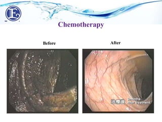 Before After
Chemotherapy
 