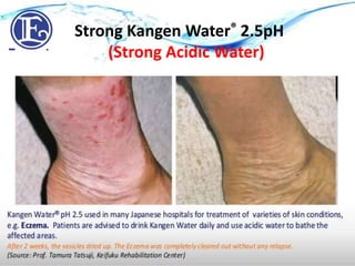 Strong Acidic Water pH 2.5 - EczemaStrong Kangen Water® 2.5pH
(Strong Acidic Water)
 