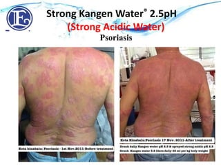 Strong Acidic Water pH 2.5 - Eczema
Strong Kangen Water® 2.5pH
(Strong Acidic Water)
Psoriasis
 